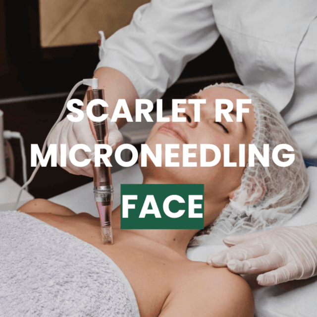 SRF Face Microneedling x3 at Snap Medical Wellness in Libertyville, IL